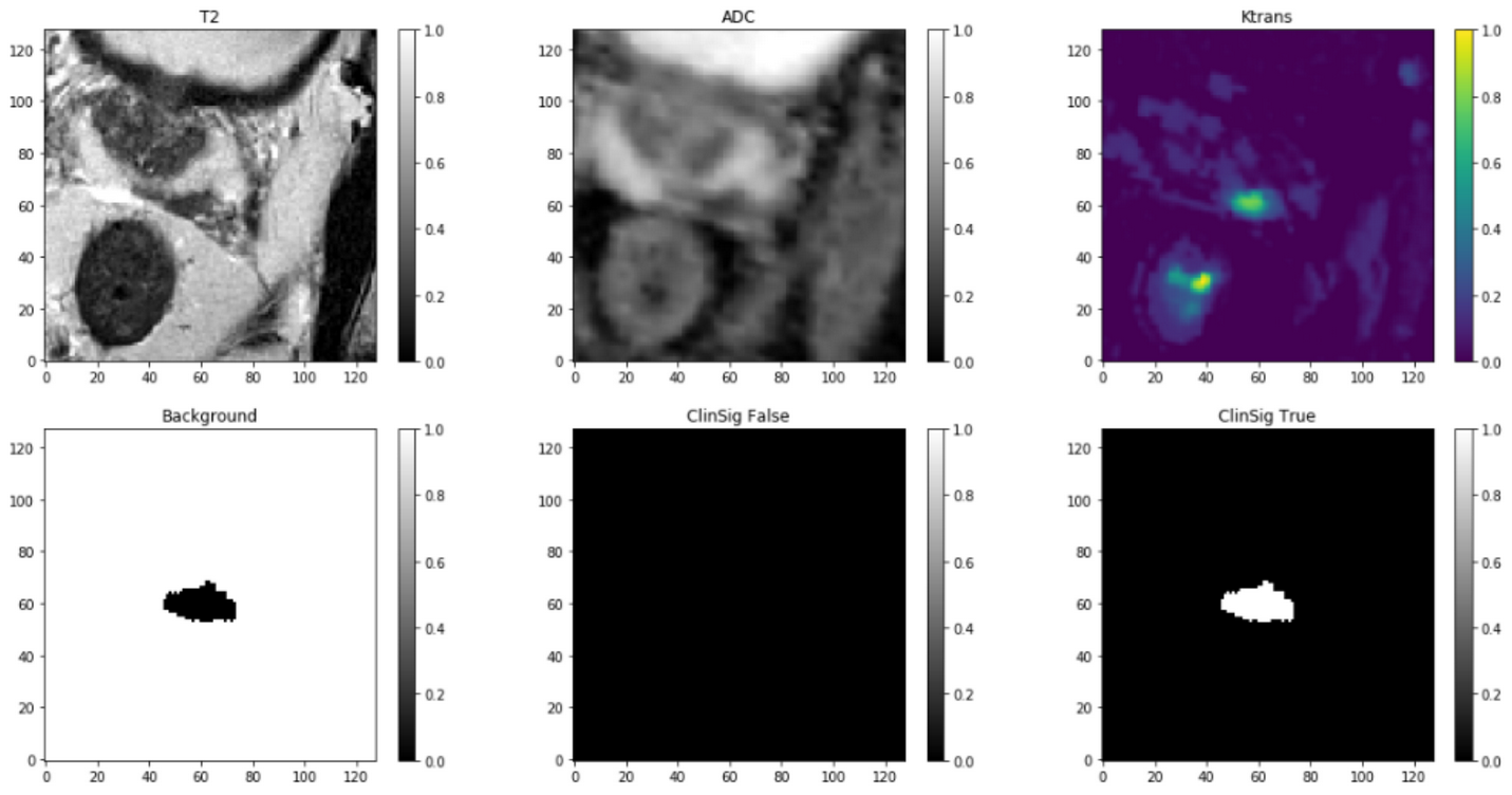 Prostate Cancer Classification | Hélène TRAN